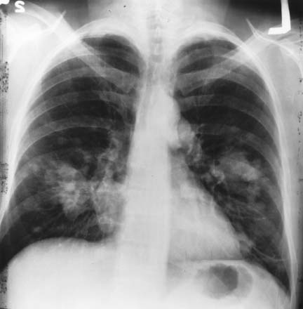 Lung xray